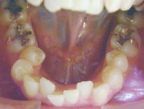 出っ歯上顎前突（治療前）