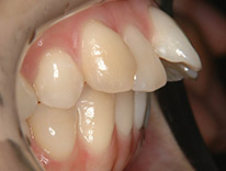 出っ歯上顎前突　舌側矯正（治療前）