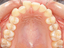 出っ歯上顎前突　舌側矯正（治療前）