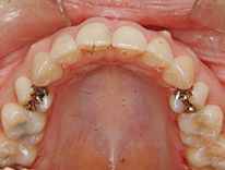 出っ歯上顎前突　舌側矯正（治療後）