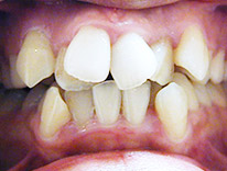 八重歯らんぐい（治療前）