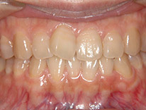 八重歯らんぐい　舌側矯正（治療前）
