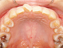 八重歯らんぐい　舌側矯正（治療前）