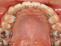 八重歯らんぐい　舌側矯正（治療中）