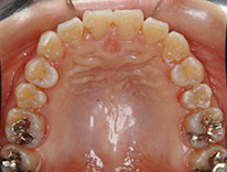 八重歯らんぐい　舌側矯正（治療後）