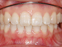 過蓋咬合　下顎前歯一歯欠損　舌側矯正（治療中）