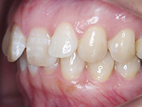 過蓋咬合　下顎前歯一歯欠損　舌側矯正（治療前）