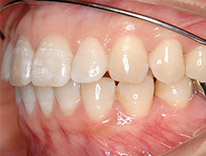 過蓋咬合　下顎前歯一歯欠損　舌側矯正（治療中）