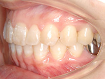 過蓋咬合　下顎前歯一歯欠損　舌側矯正（治療後）