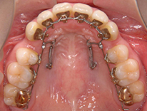 インプラント矯正（治療中）