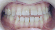すきっ歯（治療前）